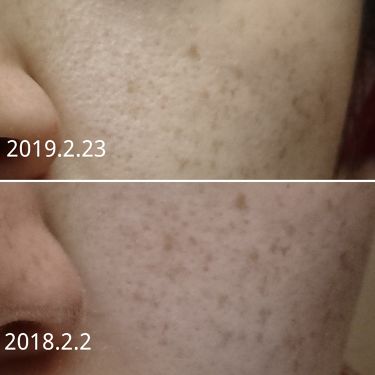 ブライトニングフォーミュラ メコゾームを使った口コミ 1年使ってこの結果 2枚目以降 とんで By みけゃん ブルベ夏 仮 乾燥肌 30代前半 Lips