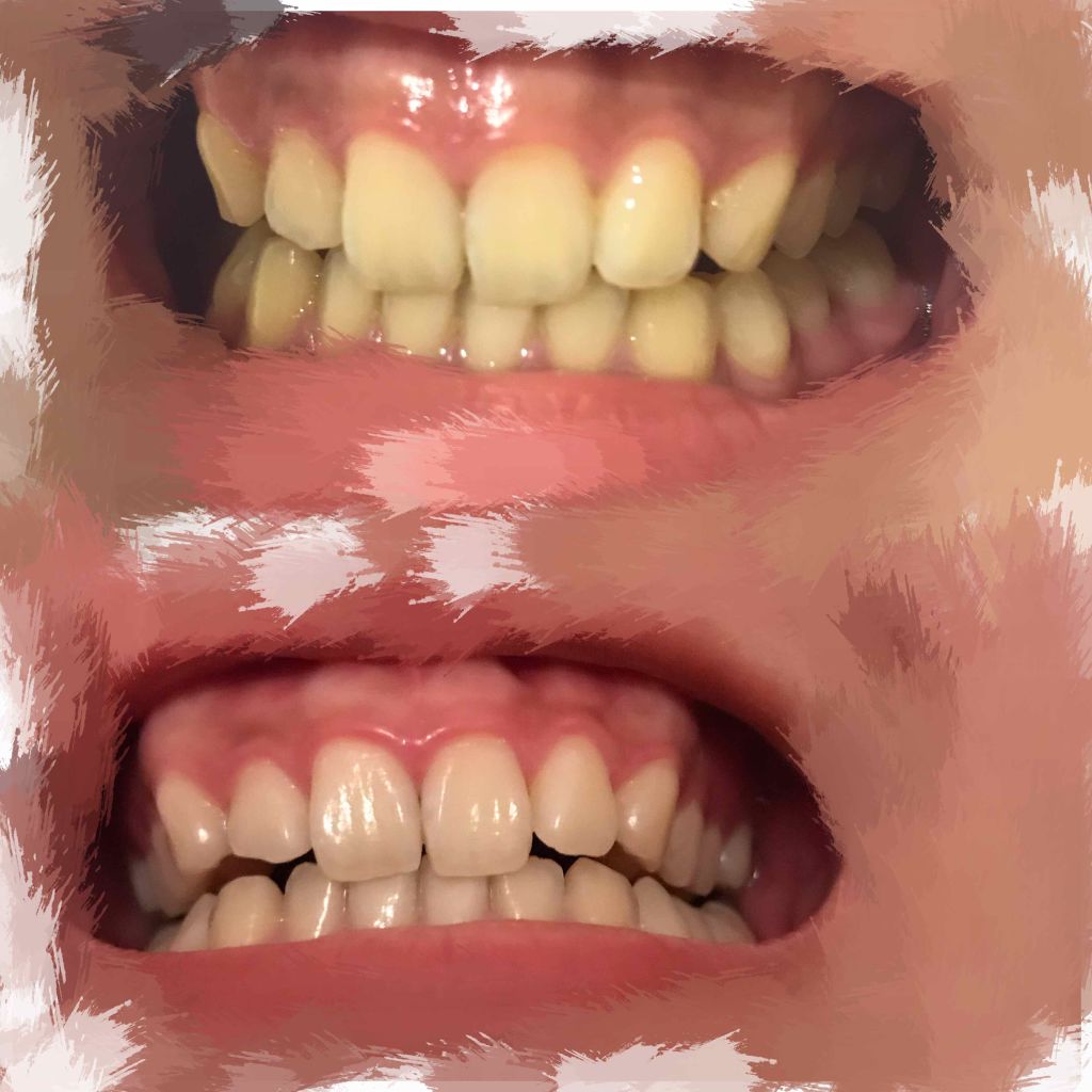 重曹つるつるハミガキ 歯磨撫子の口コミ 汚い写真を失礼 周りの子が歯が By まる 敏感肌 Lips