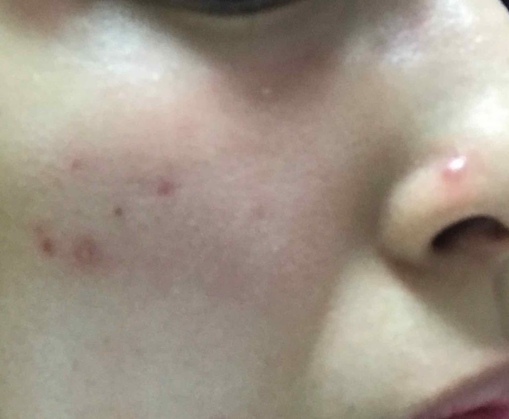 カバーパーフェクト チップ コンシーラー The Saemを使った口コミ ニキビがポツリポツリとでき始め 気がついた By Mariko 代前半 Lips