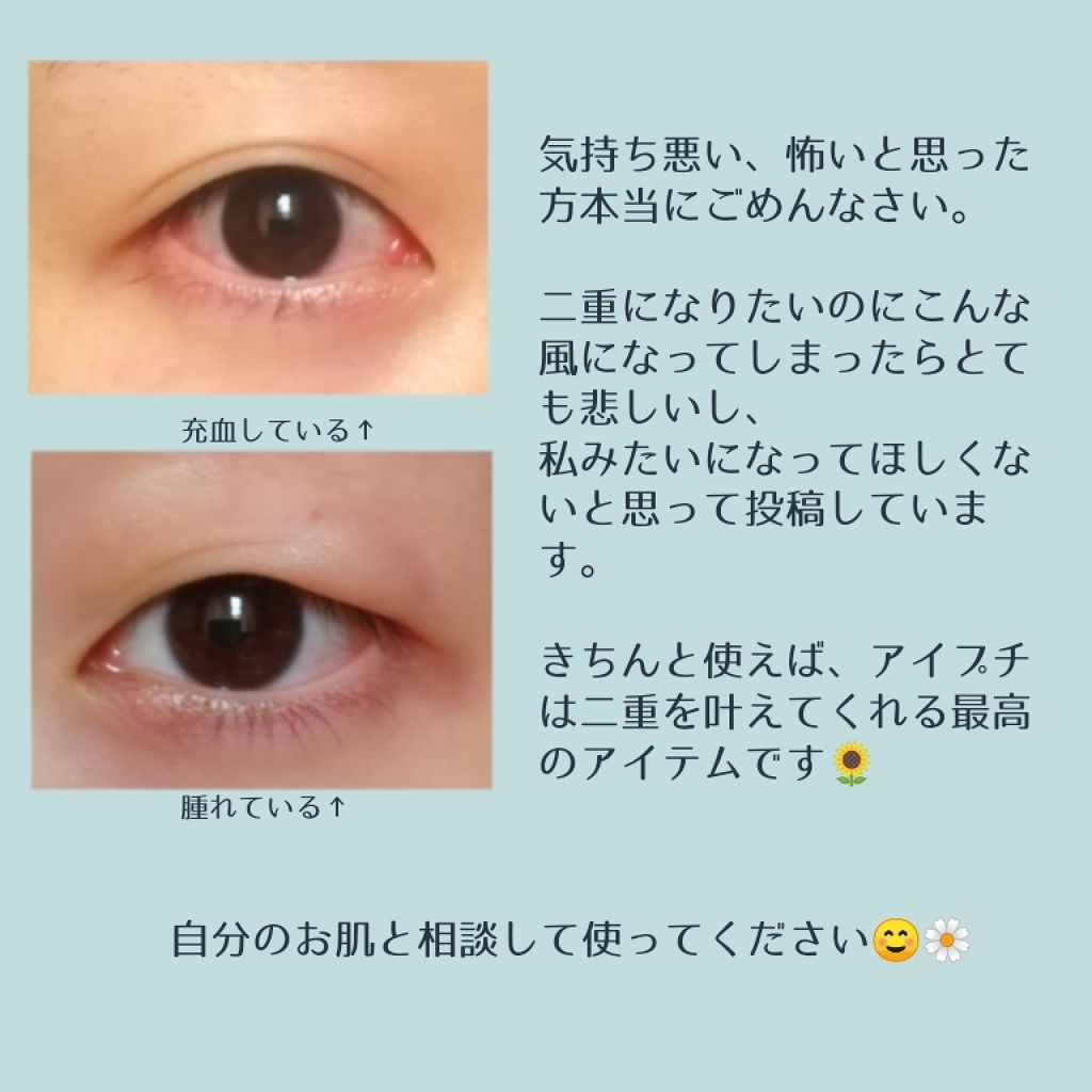 目 が 腫れ た とき 突然まぶたが腫れた 原因はアレルギー 目の腫れの原因と正しい対処法を知ろう