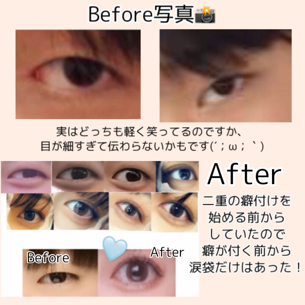 ナチュラル アイロールオン カントリー ストリームの効果に関する口コミ 涙袋爆誕 ぷっくり涙袋が手に入るマッサー By ﾘﾝｶ 乾燥肌 10代後半 Lips