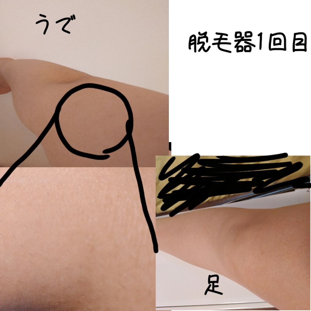 Fasiz607c Ipl光脱毛器 Fasizの口コミ ゴリラ女と言われた剛毛女がついに毛の処理を By ねねち 敏感肌 Lips