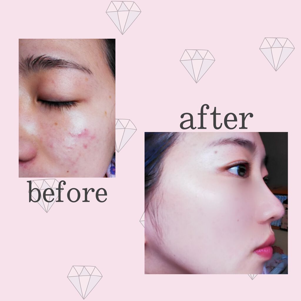 キル カバー アンプル クッション Clioの口コミ 乾燥肌におすすめのクッションファンデーション こんばんは 今回初 By あずさ 混合肌 10代後半 Lips