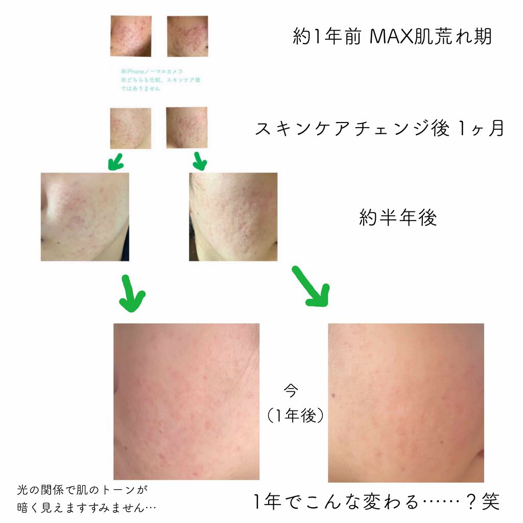 ビジャ シカバーム Ex Innisfreeの口コミ 現在ニキビ ニキビ跡に悩むそこの乙女 これ By Kirari 敏感肌 10代後半 Lips