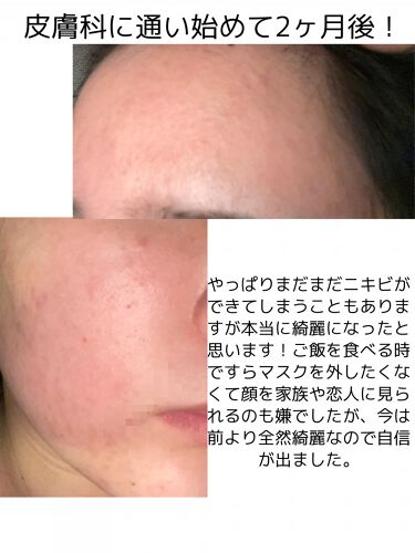 A アクネフォーム Novの効果に関する口コミ 乾燥肌におすすめの洗顔フォーム ニキビのスキンケアと皮 By りな 乾燥肌 Lips