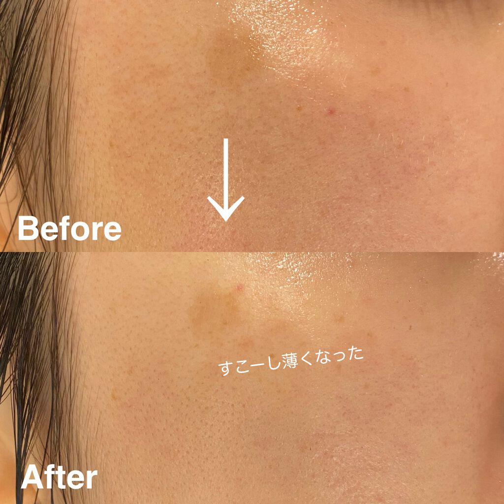 限定美容液 ホワイトロジスト ブライト コンセントレイト Cosme Decorteの効果に関する口コミ 人気コウジ酸美白美容液試してみた 使い切り By アン 普通肌 30代後半 Lips