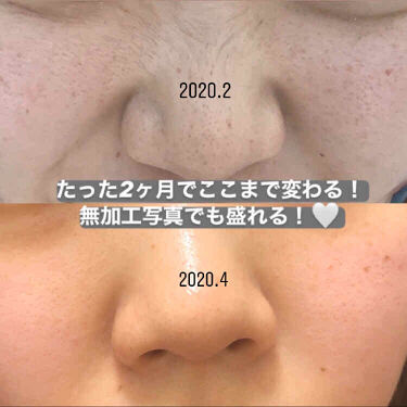 ホホバオイル 無印良品を使った口コミ 毛穴だらけが2ヶ月でここまで変わった方法 By 敏感肌 Lips