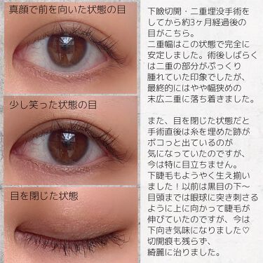 二重整形のリアルな口コミ レビュー Lips