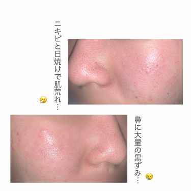 スキンケア方法 セブンデイ スクラブ クリーム リンス オフ フォーミュラ Cliniqueの使い方 効果 毛穴の黒ずみを無くし By Usamaruu 脂性肌 10代後半 Lips