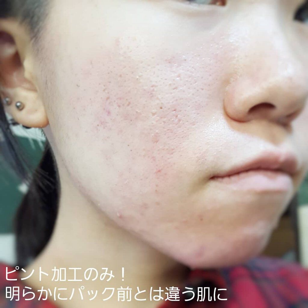炭酸パック プルリ ウツクシアの効果に関する口コミ 敏感肌におすすめの洗い流すパック マスク ウツクシアさんの 炭酸 By ぎんむぎ 混合肌 10代後半 Lips 炭酸パック プルリ ウツクシアの効果に関する口コミ 敏感肌におすすめの洗い流すパック マスク ウツクシアさんの 炭酸 By ぎんむぎ 混合肌 10代後半 Lips
