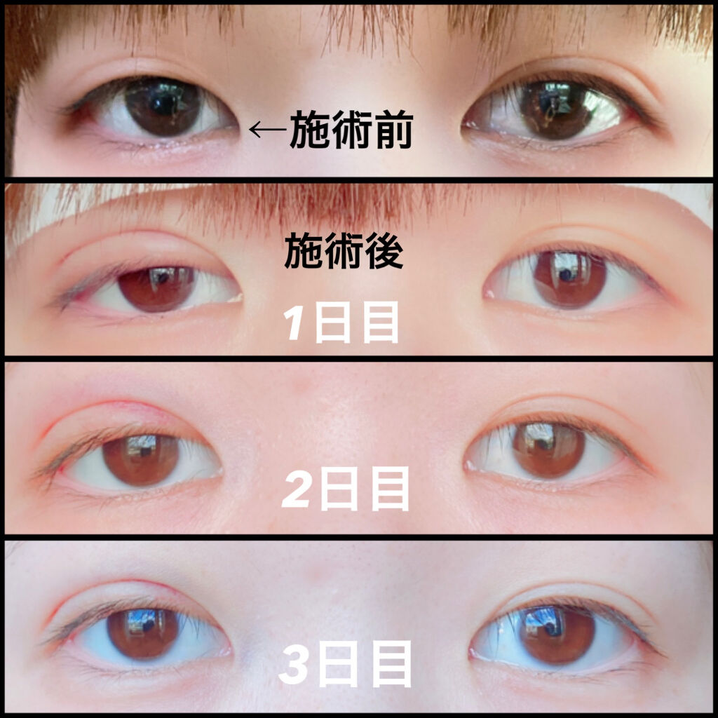 二重整形の画像 動画一覧 3ページ目 Lips