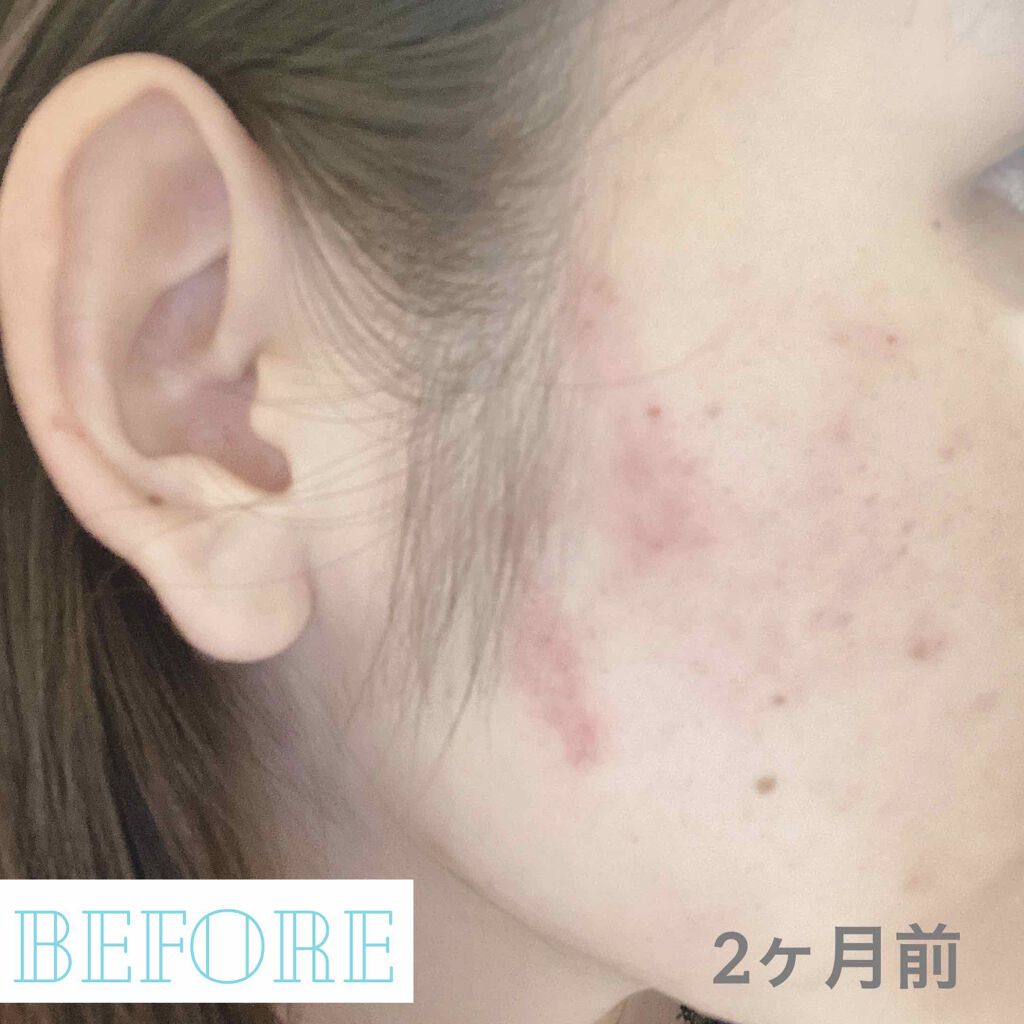 Cream Care Of Cica Tipiの効果に関する口コミ 汚肌写真あり注意 Tipiのシカクリーム By あーる 敏感肌 代前半 Lips