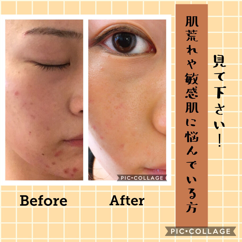 泡洗顔料 Curelを使った口コミ お金をかけずに肌荒れを治す 5つのポイント By もい 敏感肌 代前半 Lips