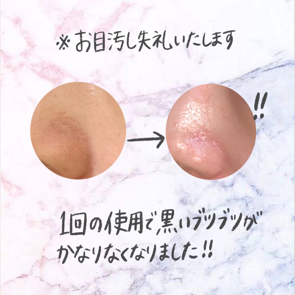 P Z Ssoc Ssoc No More Blackhead One Day S Youの使い方を徹底解説 小鼻の黒ずみ撃退 もー何をやっても全 By リーサン 混合肌 代後半 Lips