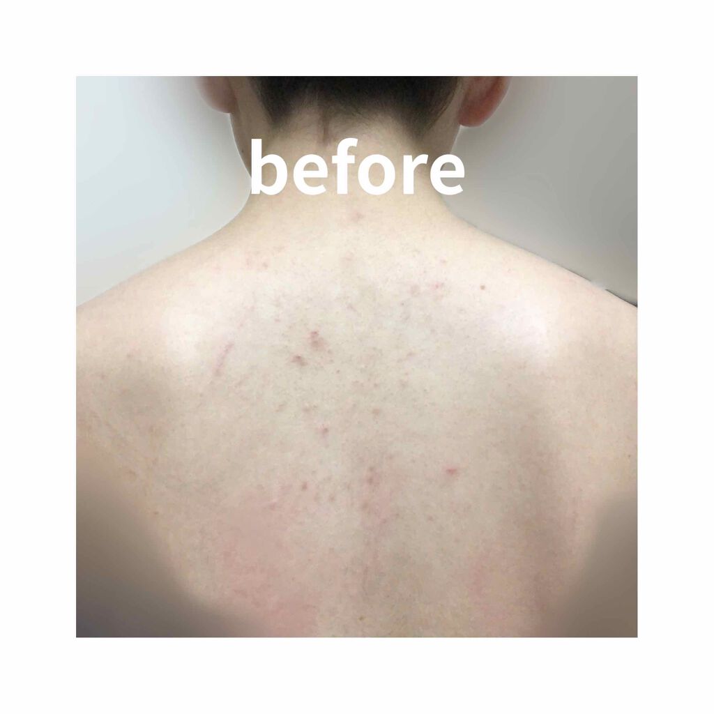 セナキュア 医薬品 小林製薬の口コミ 背中のニキビが気になり 購入しました １日 By くるみ Lips