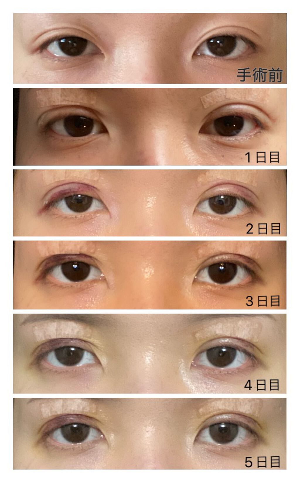 二重整形の口コミ みなさん初めまして 遂に 全切開 眼瞼下 By Mimi 乾燥肌 代後半 Lips