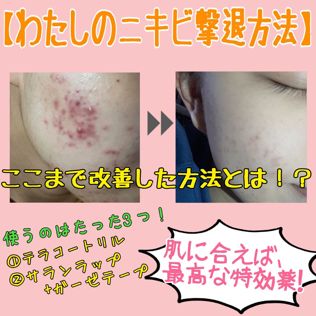 テラ コートリル 軟膏 医薬品 ジョンソン エンド ジョンソンの口コミ 私が最もニキビがひどかったときのお話 よく By ほたて 混合肌 代前半 Lips