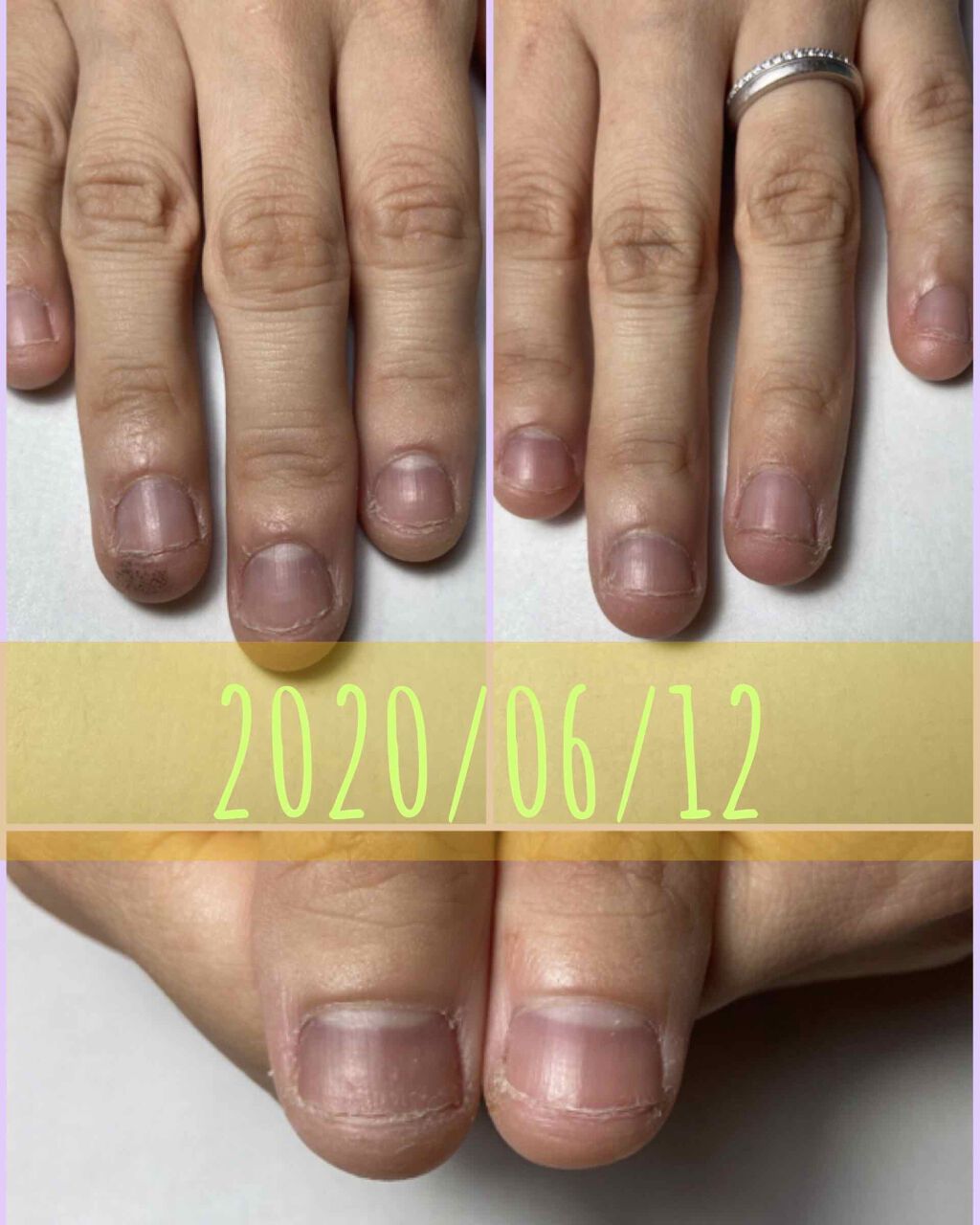 メディケイティッド エクストラクリーム アトリックスを使った口コミ 深爪矯正中の私が綺麗な爪になるまでの記録 By Okana 乾燥肌 代後半 Lips