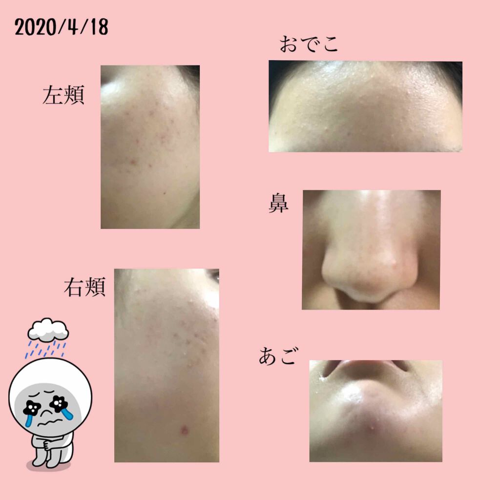 白潤 薬用美白化粧水 しっとりタイプ 肌ラボを使った口コミ 4 19ニキビ観察1日目今日から By Sari 混合肌 代前半 Lips