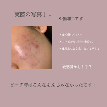 スキンケア方法 潤浸保湿 化粧水 Iii とてもしっとり キュレルの使い方 効果 はじめまして 高校生 By みる 混合肌 10代後半 Lips