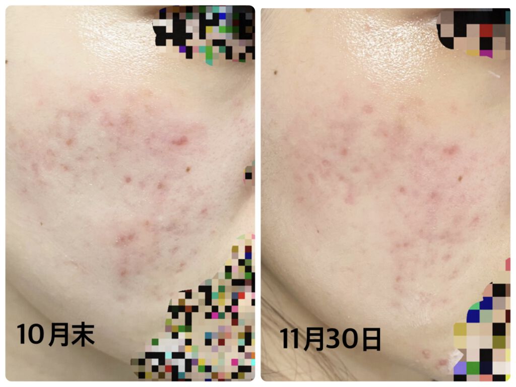 Vt Cica デイリー スージング マスク Vt Cosmeticsを使った口コミ ニキビ跡肌荒れ推移 今月思ったこと写真の通 By みずみず 混合肌 代後半 Lips