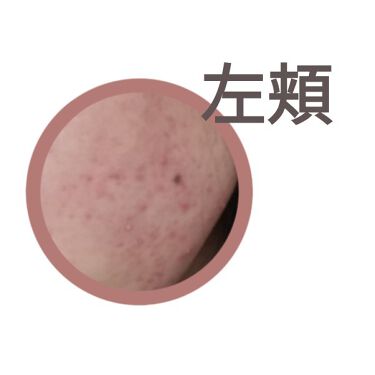 マルチビタミン 栄養機能食品 ビタミンb1 ビタミンc ビタミンe Dhcを使った口コミ 肌荒れとニキビに悩む高校生です 6日目 By ちーちょ 脂性肌 10代後半 Lips