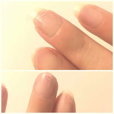 ネイルホリック ネイルホリックの口コミ 注意3枚目傷だらけ爪の写真です ネイ By Ghana 混合肌 Lips