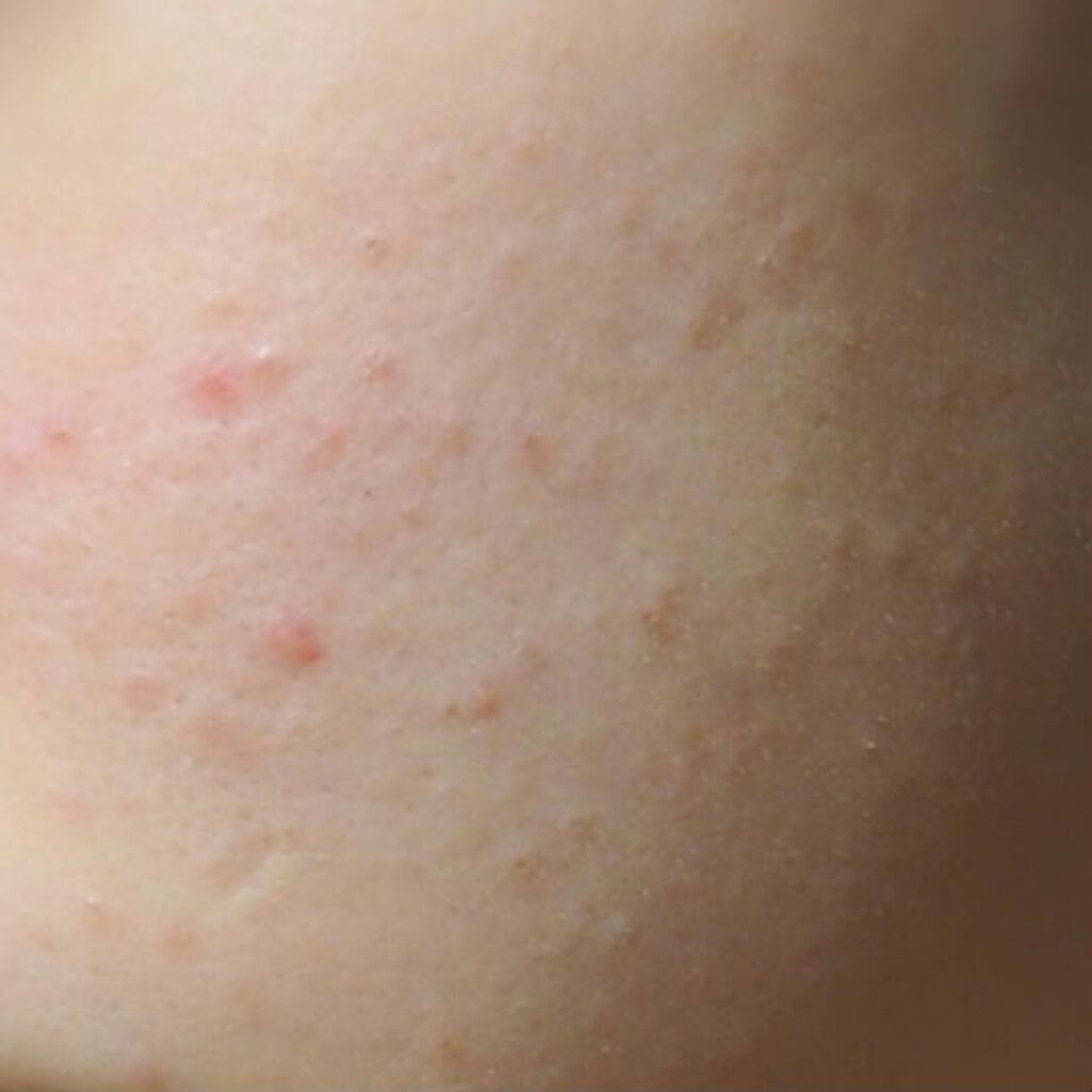 ベビーワセリン 健栄製薬を使った口コミ 肌断食はじめ By 𝒶 脂性肌 10代後半 Lips