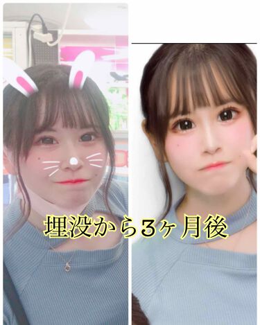 二重整形の口コミ こんばんは ふじりちゃんです 少し前の 整 By ふ じ り ち ゃ ん 脂性肌 10代後半 Lips