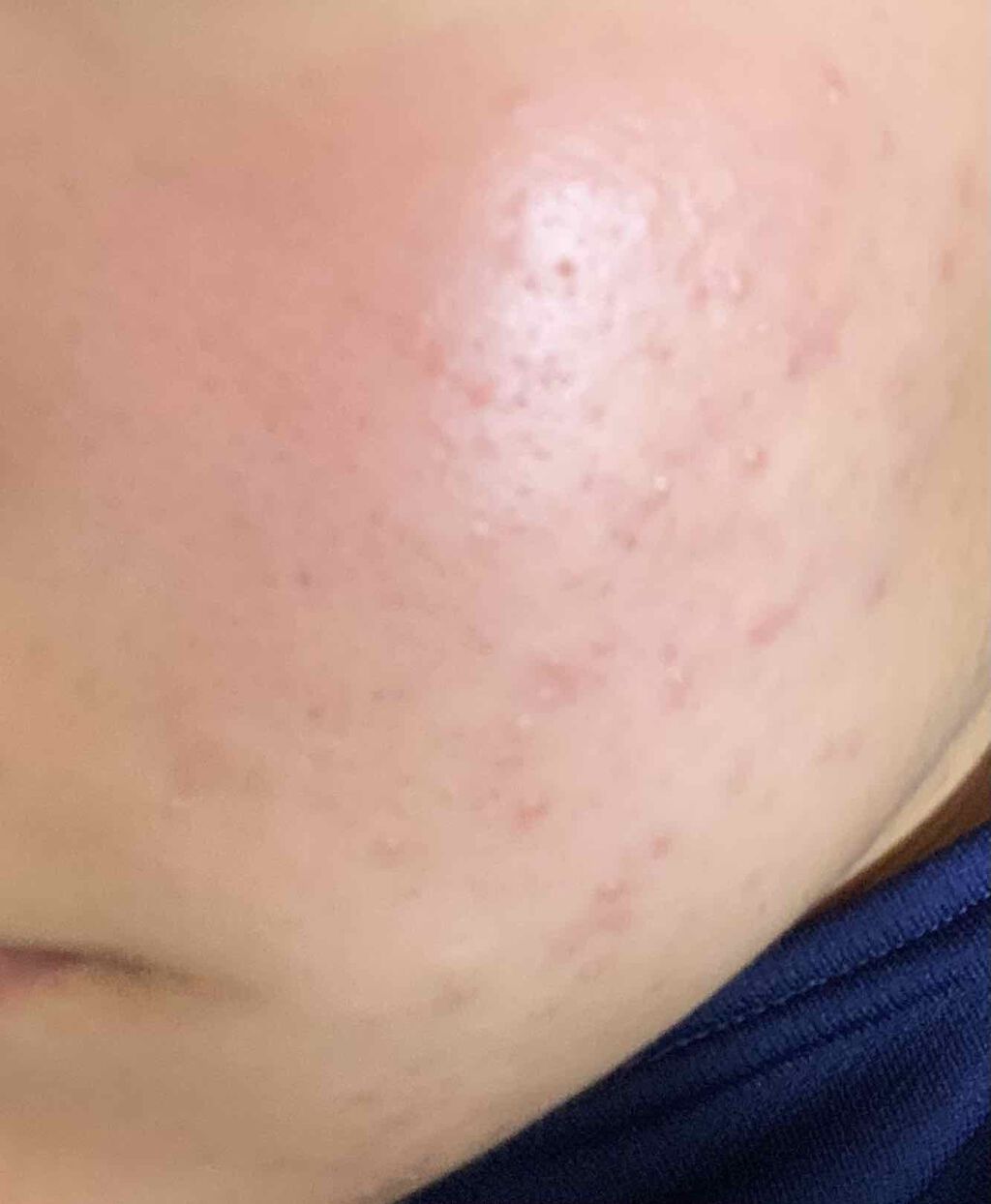 スキンケア方法 スキンピールバー Ahaマイルド サンソリットの使い方 効果 ニキビどーすればいいの By まなきんまん 脂性肌 10代後半 Lips