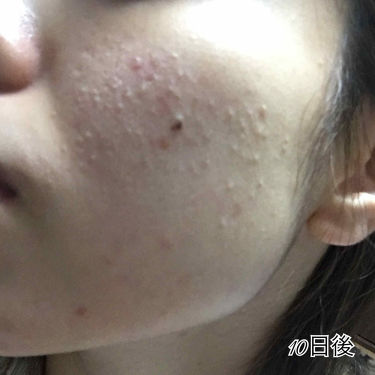 にきび治療薬c 医薬品 ピンプリットの画像 動画一覧 Lips