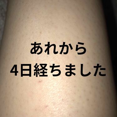 Icelady Notimeの口コミ あれから4日目の夜です 私の脚の脛の皮膚で By Ke Lips