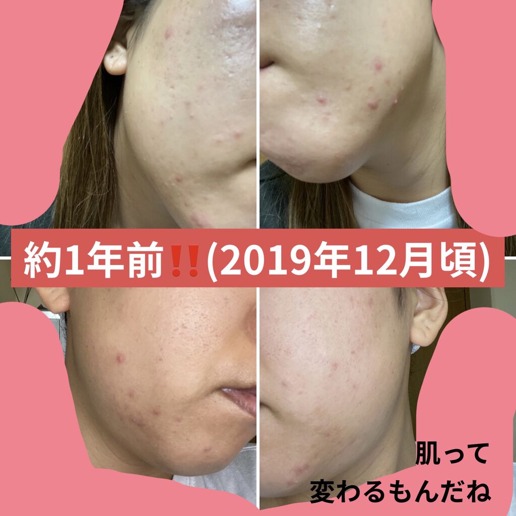 ミラミックス Zo Skin Healthを使った口コミ ゼオスキン日記 8週間経過ゼオスキン日記 By ワタクシ ブルベ冬 敏感肌 30代前半 Lips