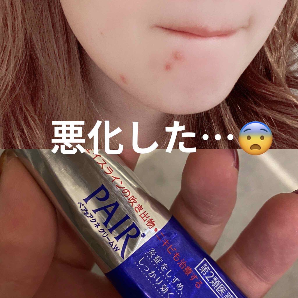 ペアアクネクリームw 医薬品 ペアを使った口コミ 口元のニキビが悪化しました ペアアクネク By Hal0614 1stブルベ夏 2ndイエベ春 混合肌 30代後半 Lips