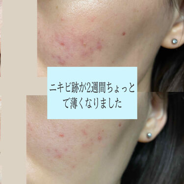 年代 肌質別 アットノン ニキビあとケアジェル アットノンの口コミ 76件 Lips