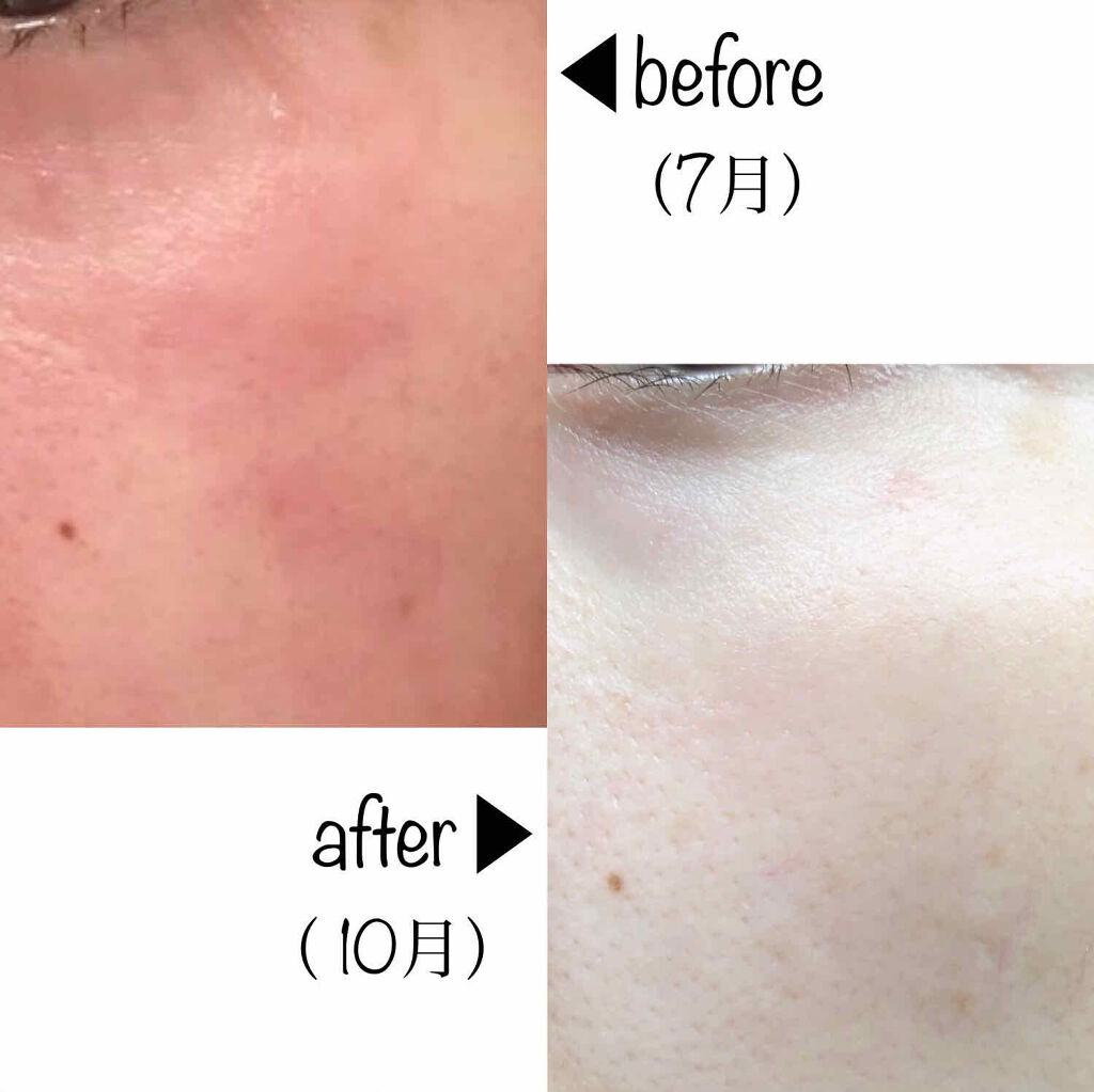 化粧水 とてもしっとりタイプ ちふれを使った口コミ スキンケアメモ マスクで肌荒れ中のスキンケ By すぷ 乾燥肌 代後半 Lips