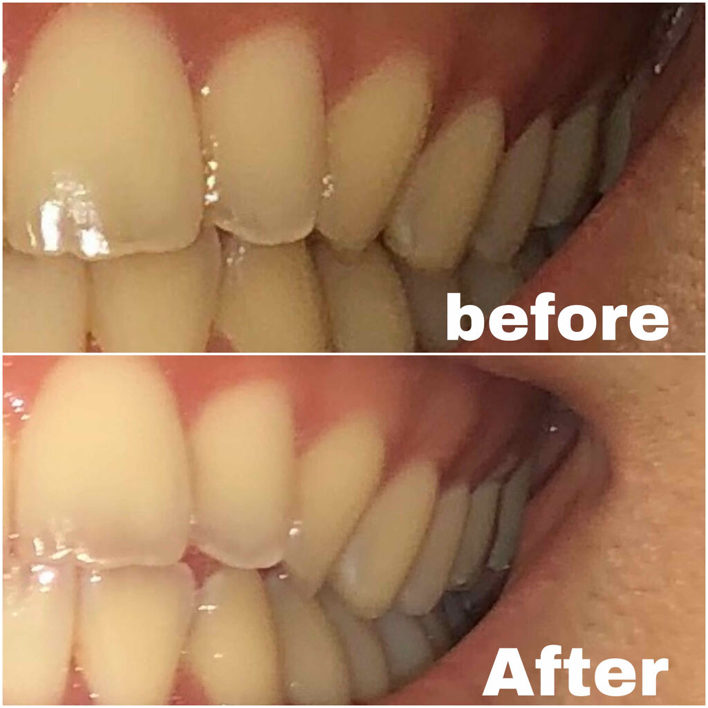 プレミアム クレンジングペースト オーラツーの口コミ 歯が黄色くてめちゃくちゃ気になる ホワイト By ひ 脂性肌 10代後半 Lips