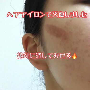 キズを早くきれいに治すパッチ Matsukiyoのリアルな口コミ レビュー Lips