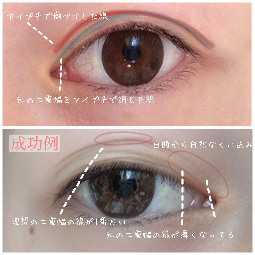 ナイトアイボーテ Streetrendの口コミ 最近の私の二重幅の広げ方 Tobibiです By Tobibi 普通肌 代前半 Lips