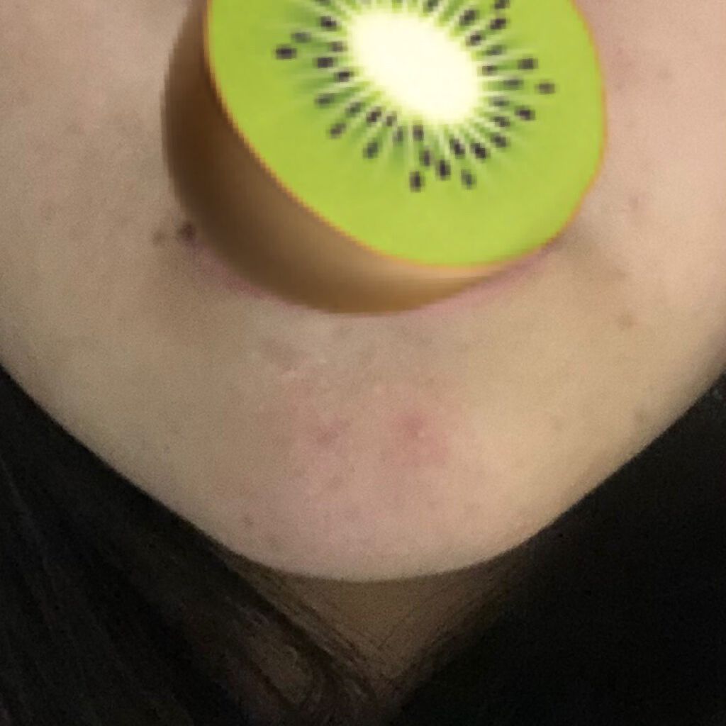 スキンケア方法 化粧水 敏感肌用 高保湿タイプ 無印良品の使い方 効果 おれとにきび 2枚目 By なゆ 混合肌 10代後半 Lips