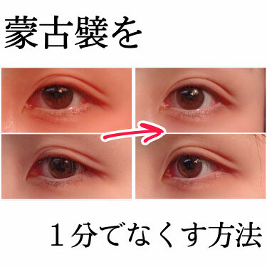 蒙古 襞 なくす 方法 目頭切開 二重まぶた 二重瞼 蒙古ヒダ 蒙古ひだ 美容整形の高須クリニック