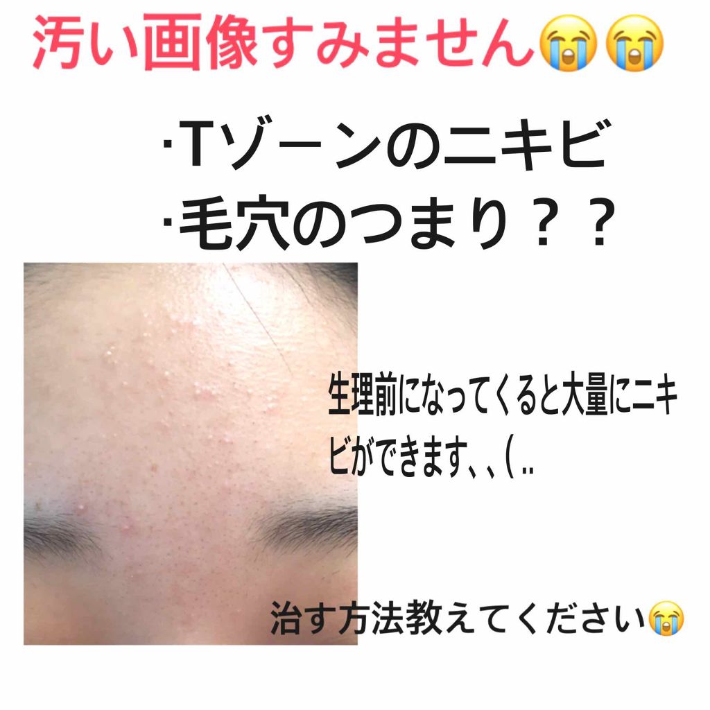 薬用 しみ 集中対策 美容液 メンソレータム メラノccを使った口コミ 画像閲覧注意 はじめまして ༥ 恥ず By ぴぴ 混合肌 10代後半 Lips