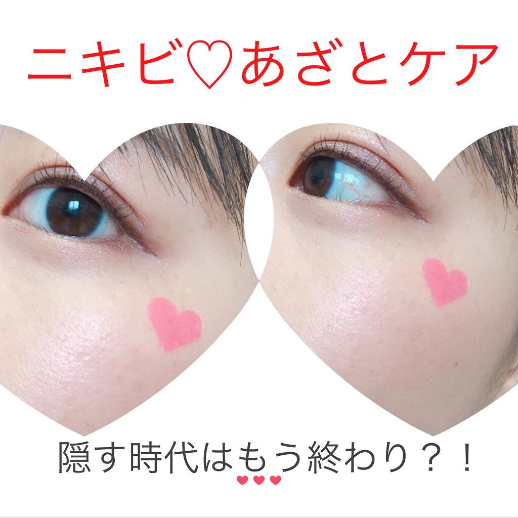 Love Me Skin Patch コジットの使い方を徹底解説 ニキビは魅せる時代へ 透明でお馴染みニキ By ぴーちゃん 敏感肌 Lips