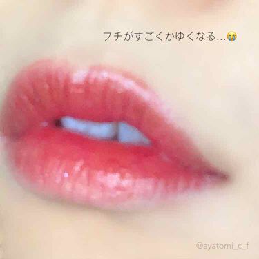 赤い口紅の人とキスする時はアレルギーの危険を覚悟するように 院長ブログ 五本木クリニック