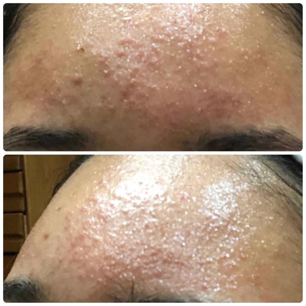 ベピオゲル 医薬品 の辛口レビュー 副作用覚悟しながらべピオゲルを使ったら By Rana 敏感肌 Lips