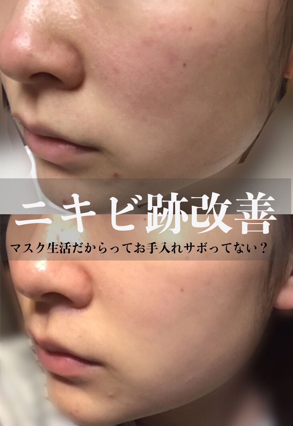 美白化粧水 Vc ちふれを使った口コミ ニキビ跡が深刻になる前に年齢的にニキビが By ｼ ｵ ﾘ 普通肌 10代後半 Lips