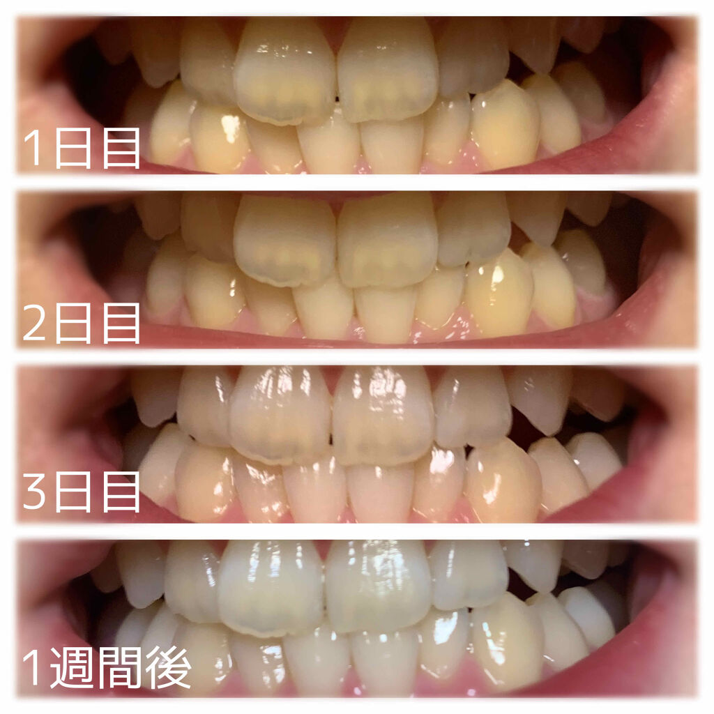 歯 を 白く する 方法 重曹