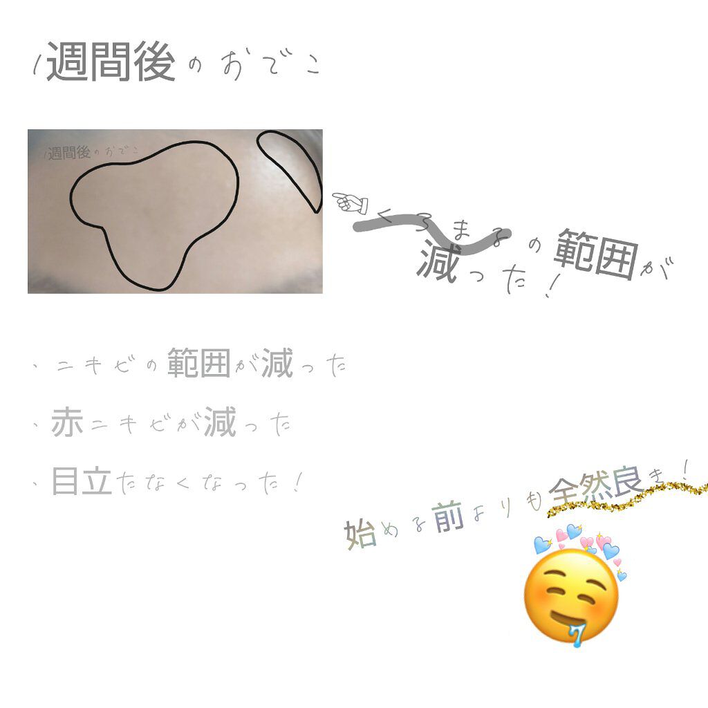 ロゼット洗顔パスタ アクネクリア ロゼットを使った口コミ 投稿するの遅くなってすみません 少し体調 By なナチョス 敏感肌 10代前半 Lips