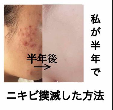 スキンケア方法 ニキビ治療薬 医薬品 メンソレータム アクネスの使い方 効果 こんにちは さよならニ By さよならニキビちゃん 混合肌 10代後半 Lips