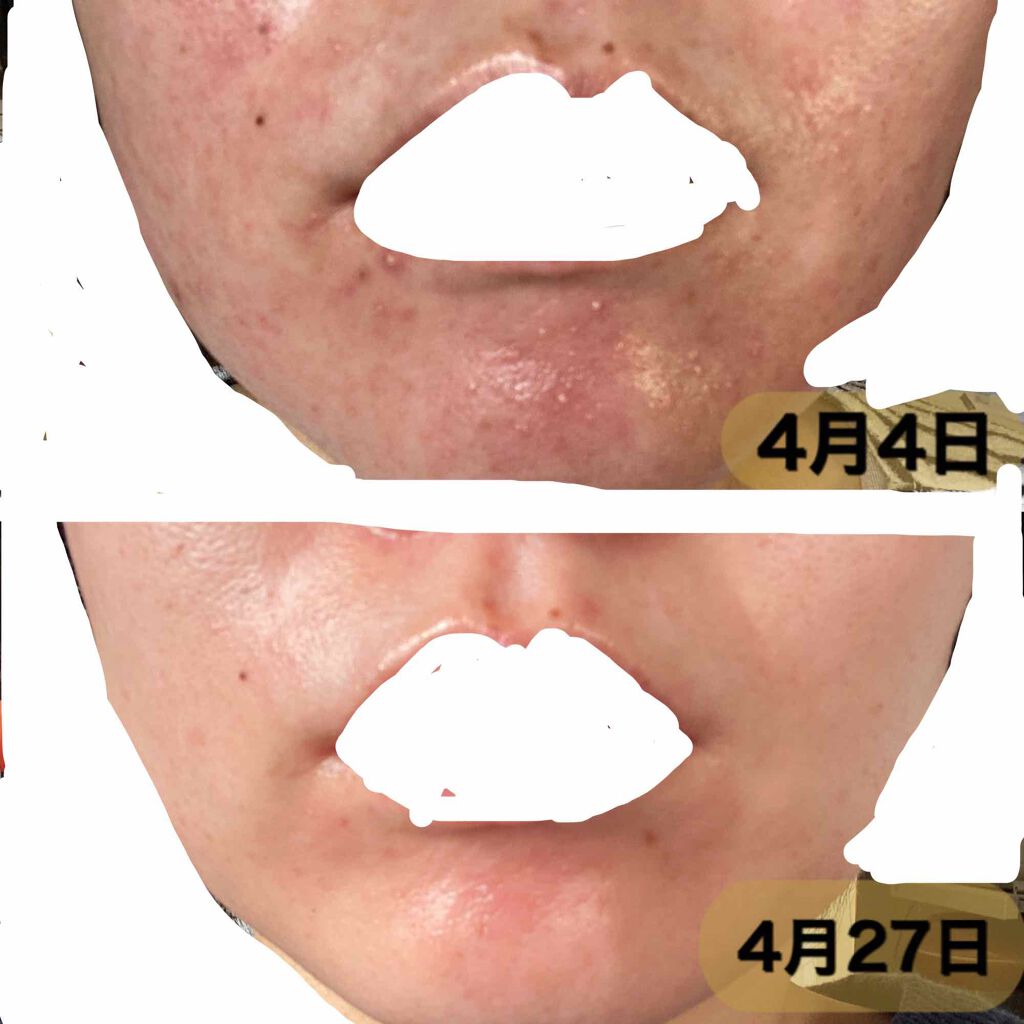 ベピオゲル 医薬品 の口コミ こんばんは 自宅待機が長引きそうですが皆さ By Amin 敏感肌 30代前半 Lips